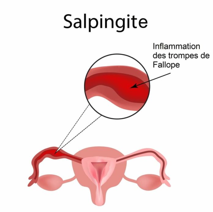 infections de trompes-salpingite