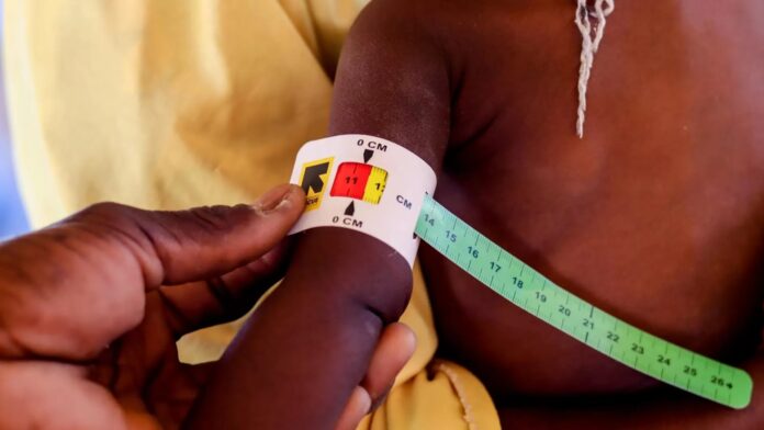 Malnutrition